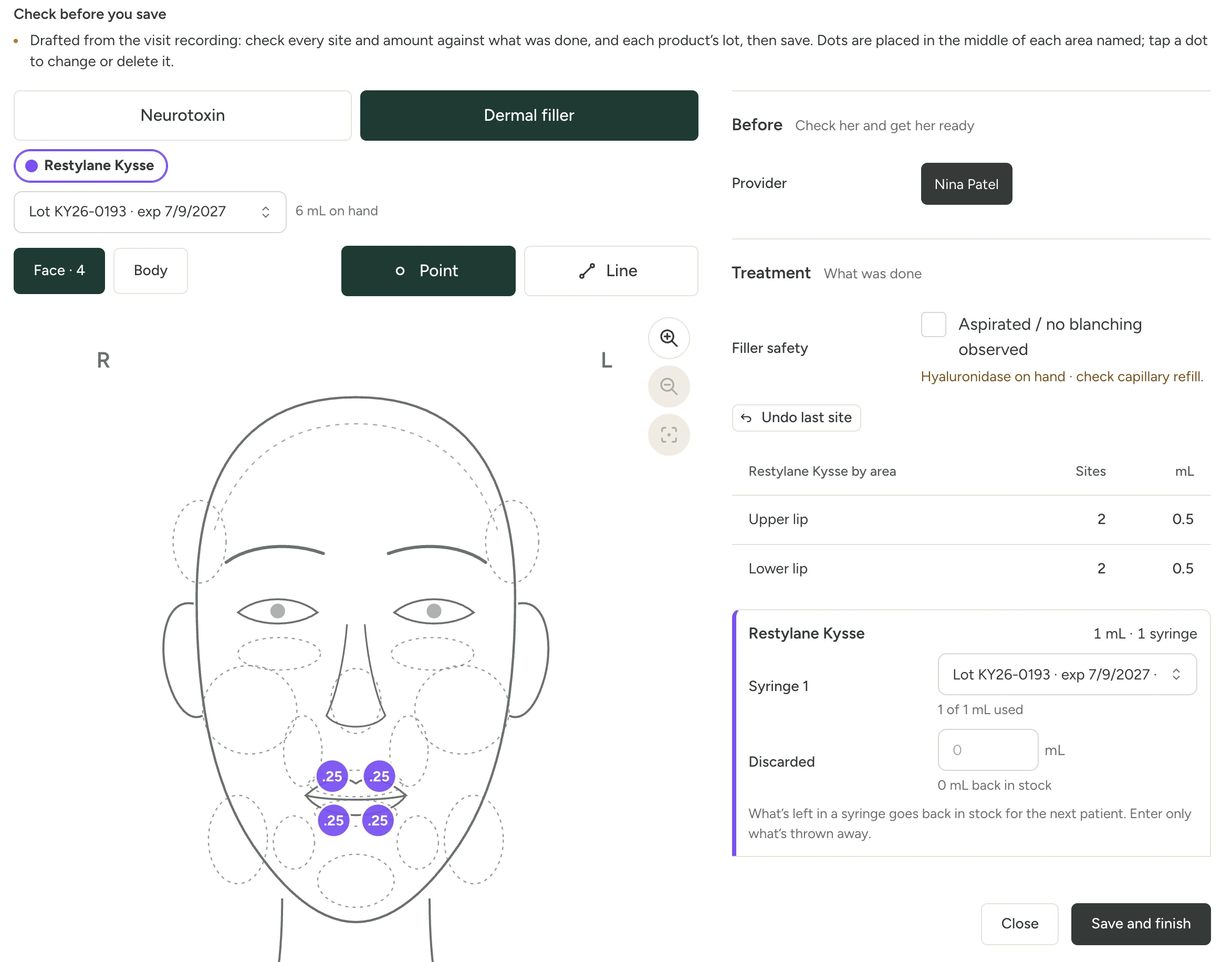 Marge’s injection chart, drafted from the visit recording for a lip filler: dots on the upper and lower lip of a face diagram with the amount at each, Restylane Kysse 0.5 mL upper lip and 0.5 mL lower lip, and syringe 1 from lot KY26-0193 with its expiry date.